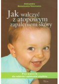 Jak walczyć z atopowym zapaleniem skóry