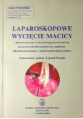 Laparoskopowe wycięcie macicy