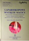 Laparoskopowe wycięcie macicy
