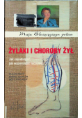 Żylaki i choroby żył