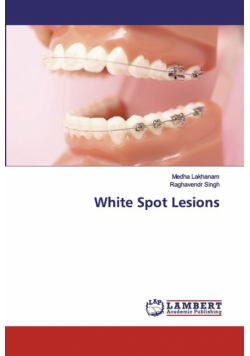 White Spot Lesions