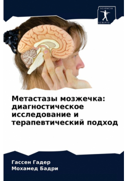 Метастазы мозжечка