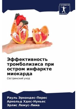 Эффективность тромболизиса при остром инфаркте миокарда