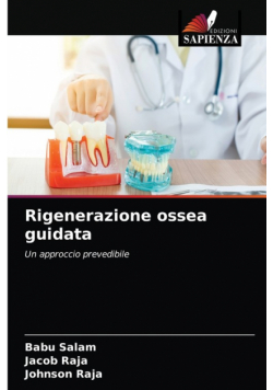 Rigenerazione ossea guidata