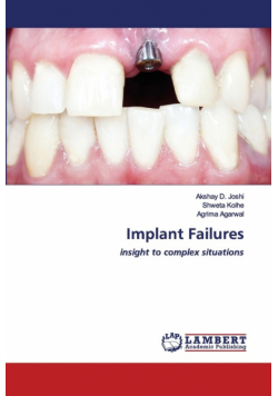 Implant Failures