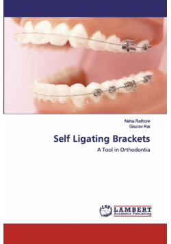 Self Ligating Brackets