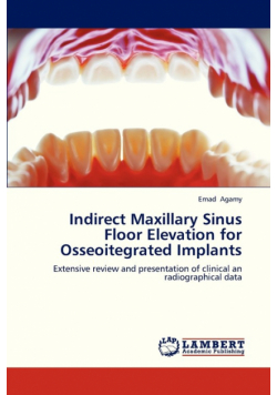 Indirect Maxillary Sinus Floor Elevation for Osseoitegrated Implants