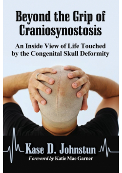 Beyond the Grip of Craniosynostosis