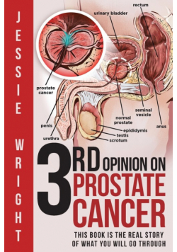 3rd Opinion on Prostate Cancer