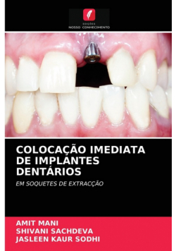 Colocação Imediata De Implantes Dentários