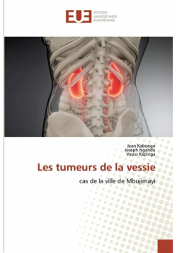 Les tumeurs de la vessie