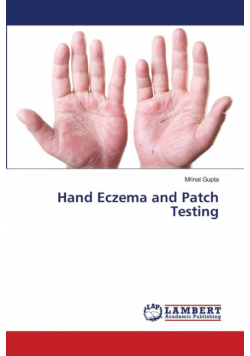 Hand Eczema and Patch Testing