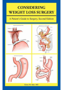 Considering Weight Loss Surgery