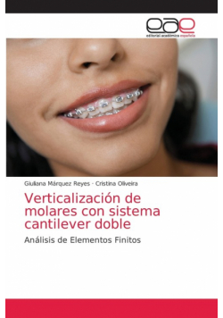 Verticalización de molares con sistema cantilever doble