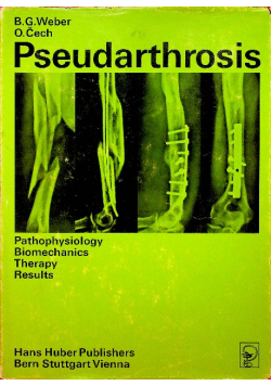 Pseudarthrosis