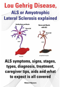 Lou Gehrig Disease, ALS or Amyotrophic Lateral Sclerosis Explained. ALS Symptoms, Signs, Stages, Types, Diagnosis, Treatment, Caregiver Tips, AIDS and