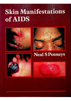 Skin Manifestations of AIDS