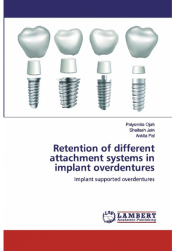 Retention of different attachment systems in implant overdentures