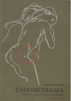 Endometrioza