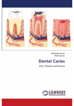 Dental Caries