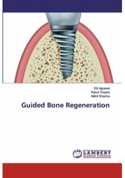 Guided Bone Regeneration