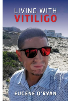 Living with Vitiligo
