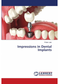 Impressions in Dental Implants