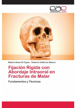 Fijación Rígida con Abordaje Intraoral en Fracturas de Malar