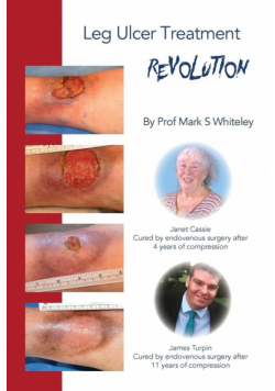 Leg Ulcer Treatment Revolution