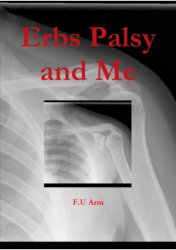 Erbs Palsy and Me