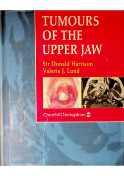 Tumours of the upper jaw