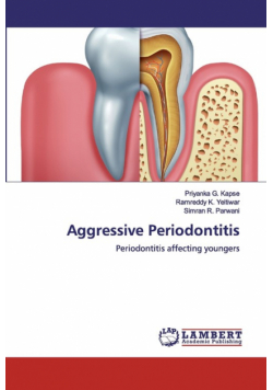 Aggressive Periodontitis