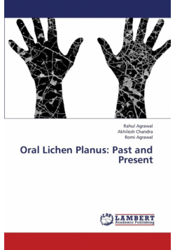 Oral Lichen Planus